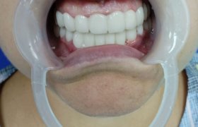 Фото зубова после лечения в стоматологии Цюань Юй – Китай, г. Хэйхэ