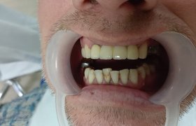 Фото зубов перед лечением в стоматологии Цюань Юй – Китай, г. Хэйхэ