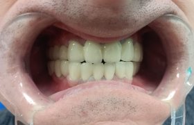 Фото зубова после лечения в стоматологии Цюань Юй – Китай, г. Хэйхэ